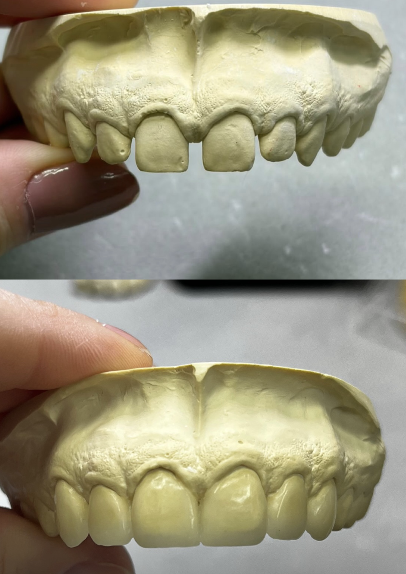 Enceramento diagnóstico antes e depois